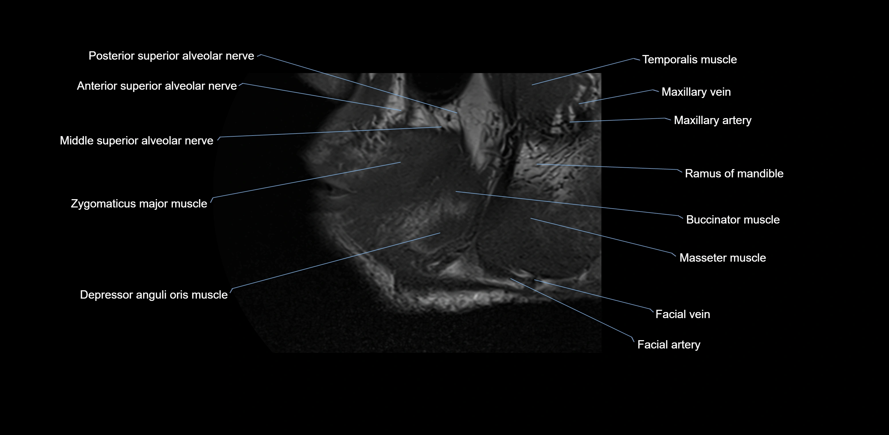 Dental MRI( tooth) sagittal labelled  cross sectional 3T anatomy -img-00001-00001.webp